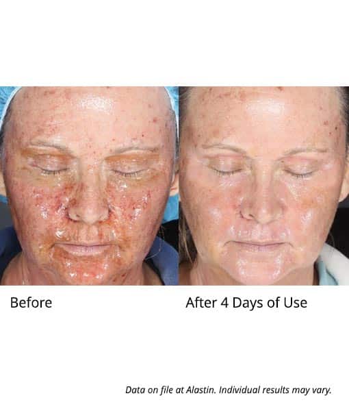 Alastin Skin Nectar results after 4 days of use