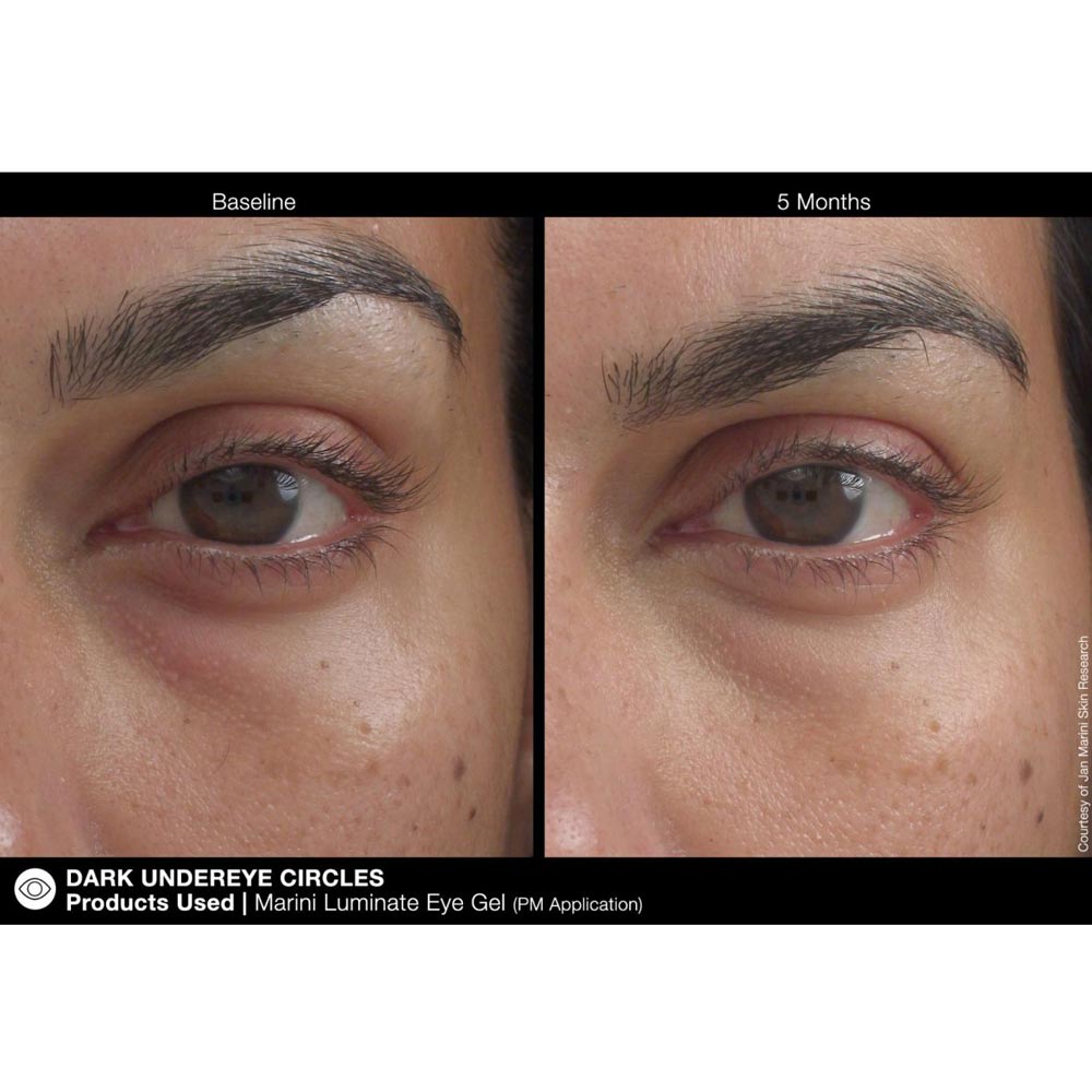 Jan Marini Luminate Eye Gel dark circles results