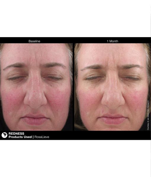 Jan Marini Rosalieve Before and after 2