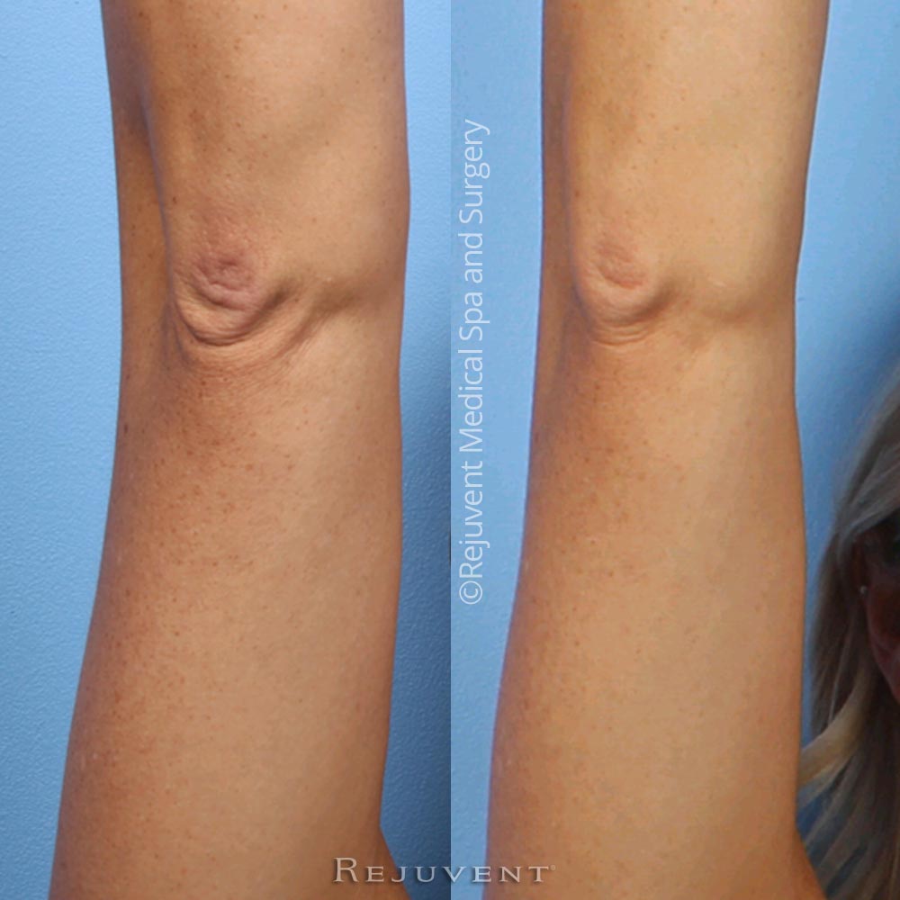 Rejuvent Skincare Closeup of elbow improvement after BodContour lotion