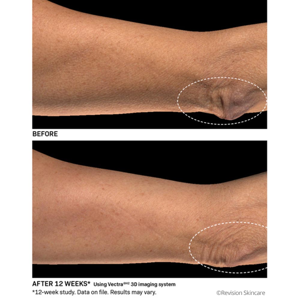Closeup of elbow improvement after BodiContour lotion