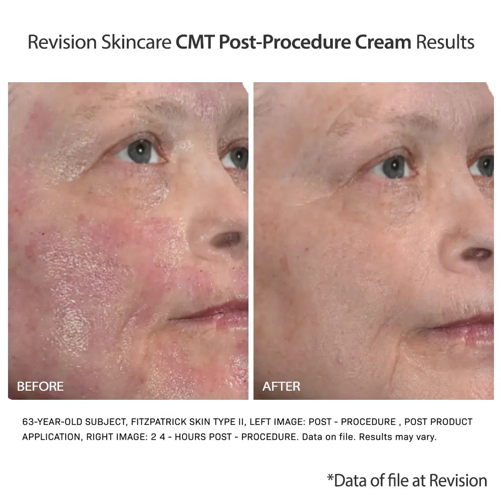 Revision Skincare CMT Post-Procedure Cream results show less redness and irritation on older skin
