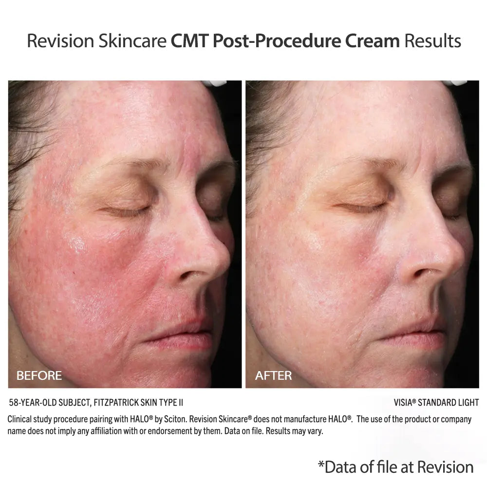 Revision Skincare CMT Post-Procedure Cream results show less redness and irritation post HALO treatment