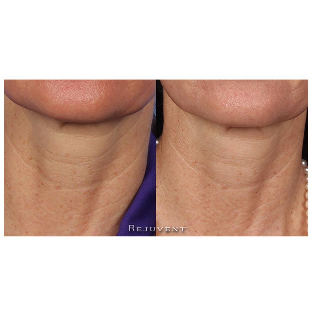 Revision Nectifirm Before and After results