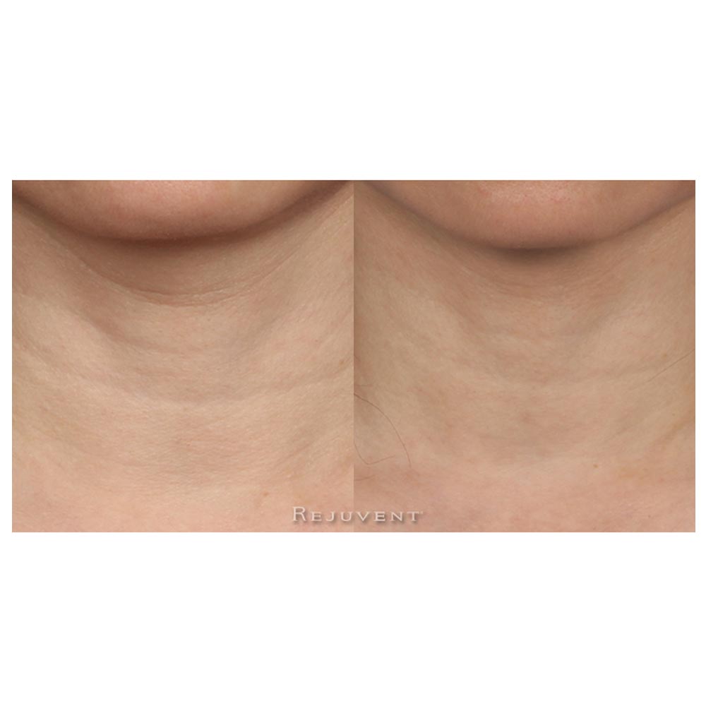 Revision Nectifirm Before and After results