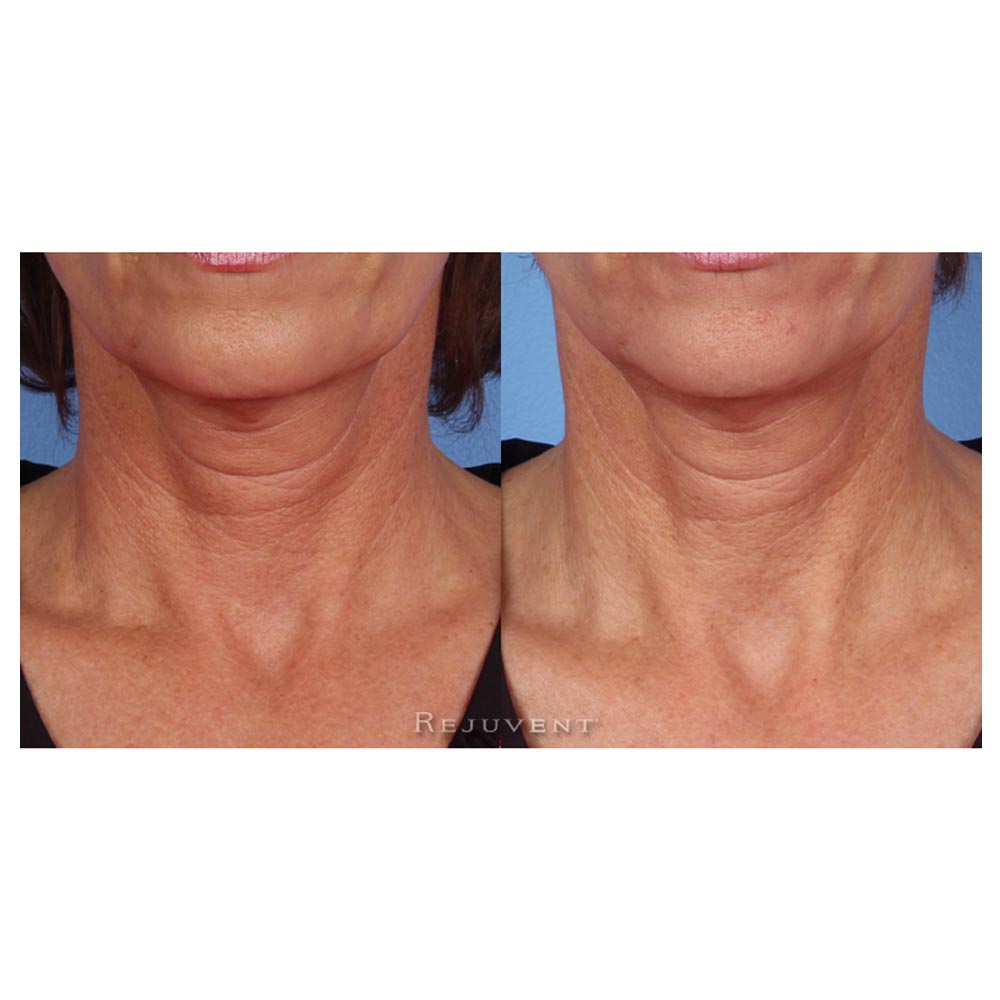 Revision Nectifirm Before and After results