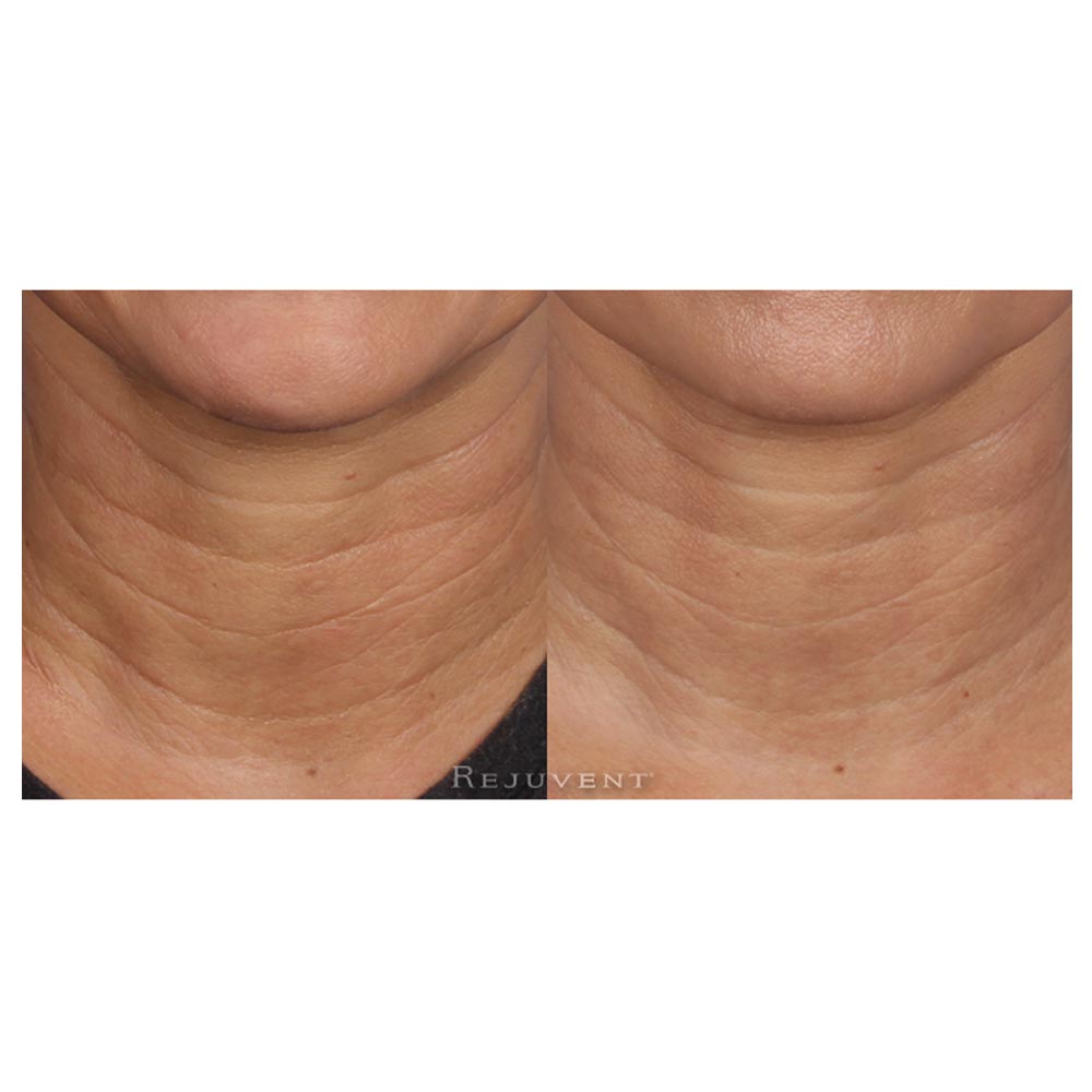 Revision Nectifirm Before and After results