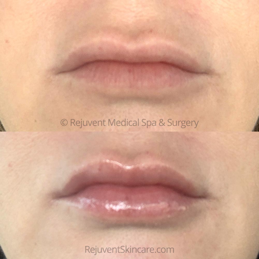 Rejuvent patient Before and after results of YouthFull Lip Replenisher