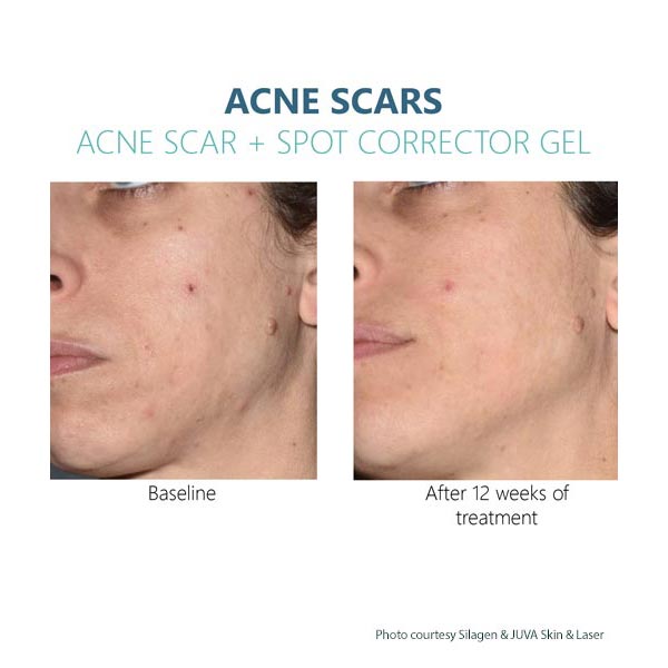 Silagen Acne Scar gel Results 1