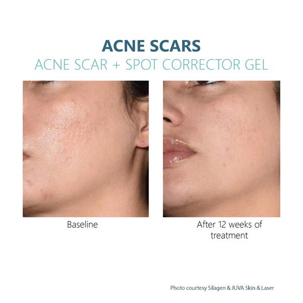 Silagen Acne Scar gel Results 2