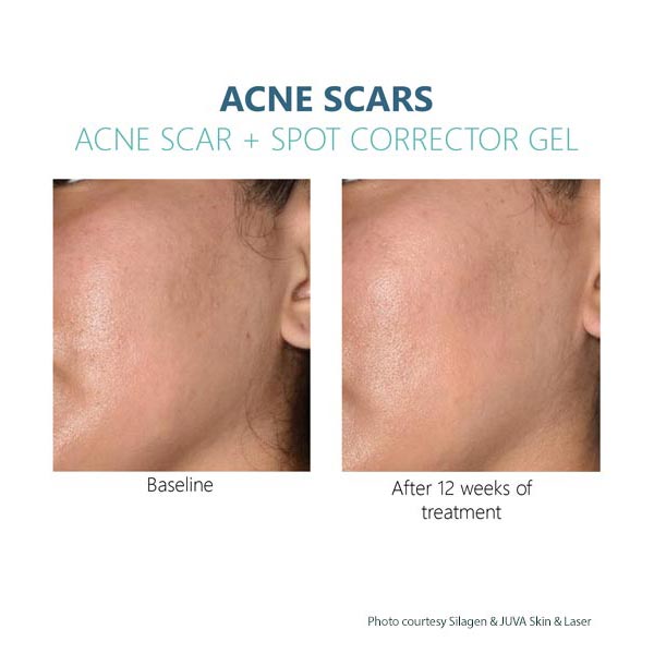 Silagen Acne Scar gel Results 3