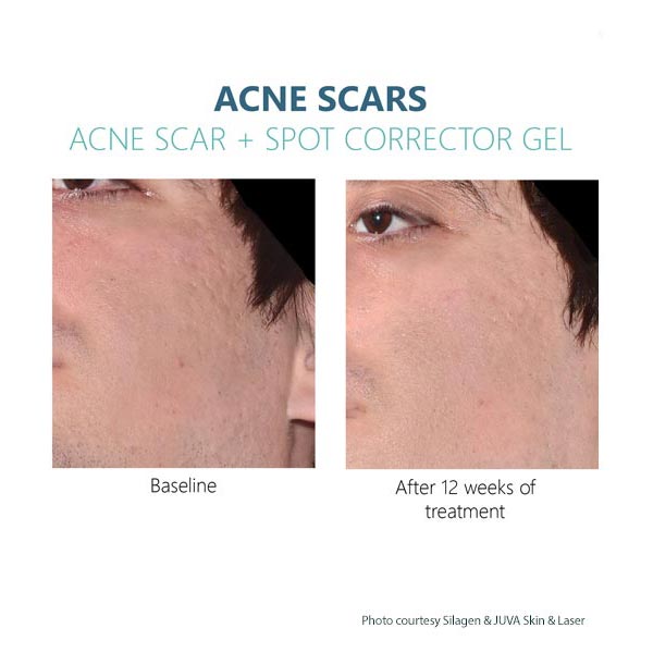 Silagen Acne Scar gel Results 4