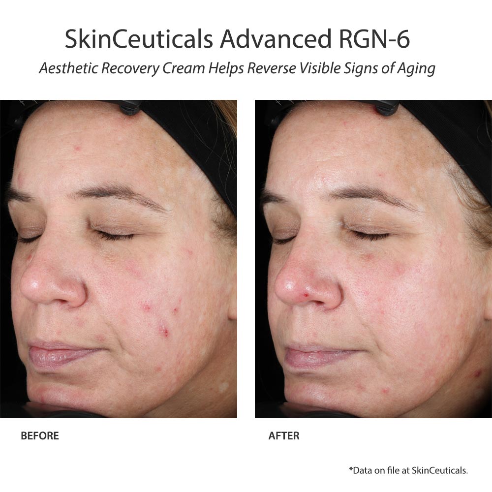 SkinCeuticals Advanced RGN-6