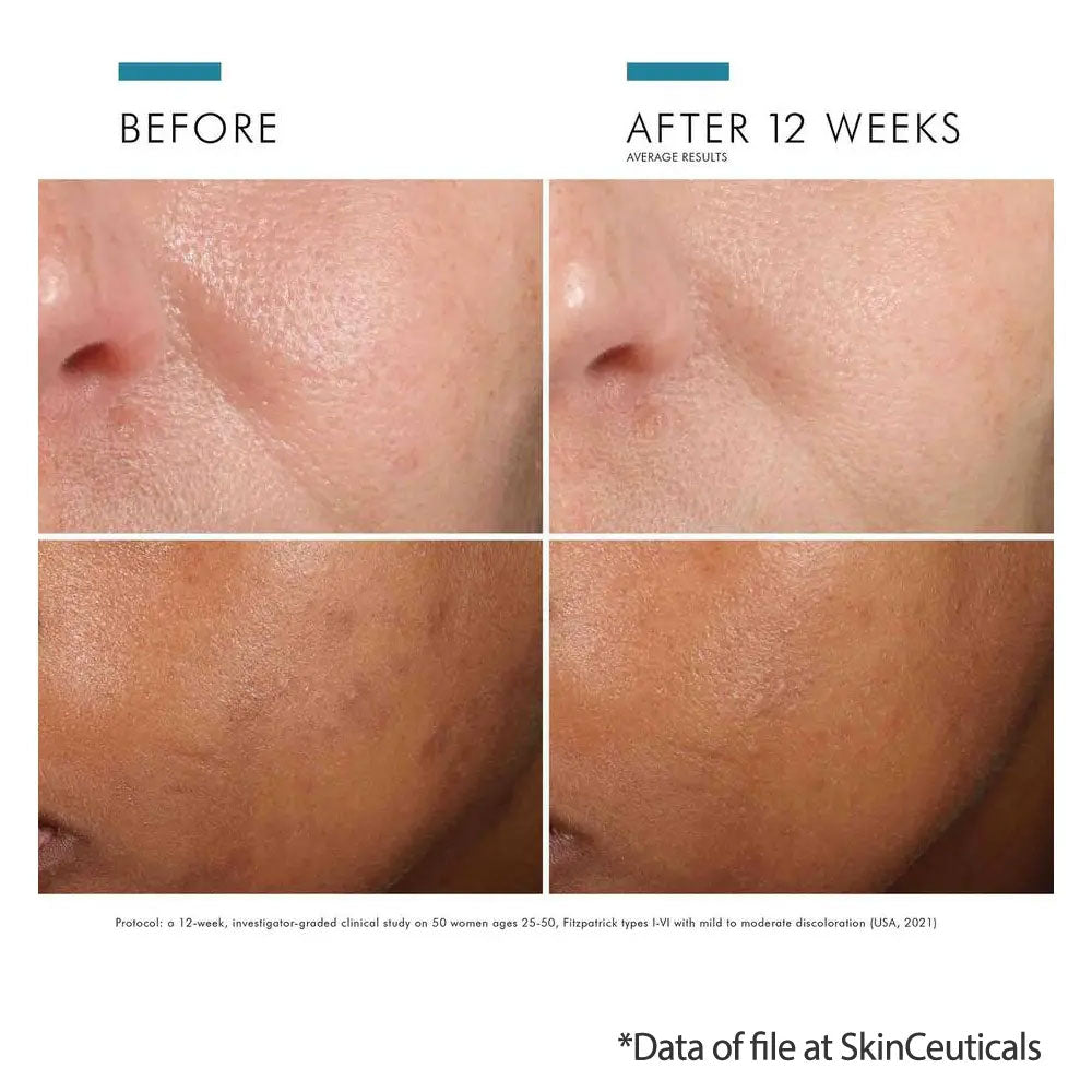 SkinCeuticals Phloretin CF results on light and dark skin