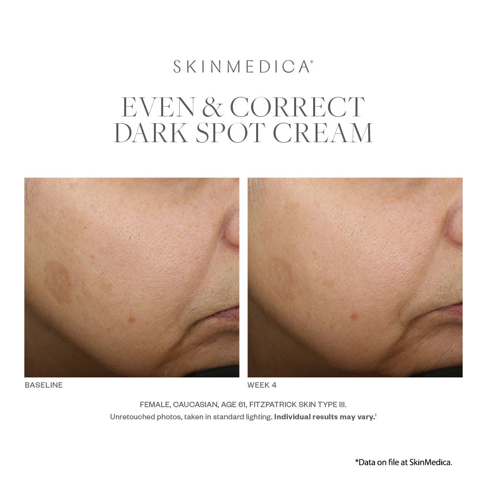 SkinMedica Even and Correct Dark Spot Cream Results on white skin customer