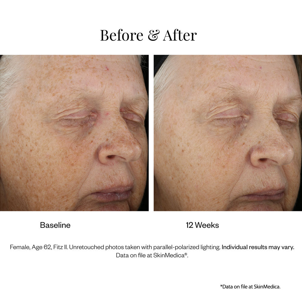 Lumivive day night System from SkinMedica results 2
