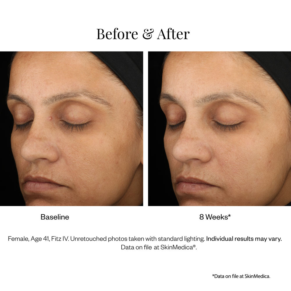 Lumivive day night System from SkinMedica results 3