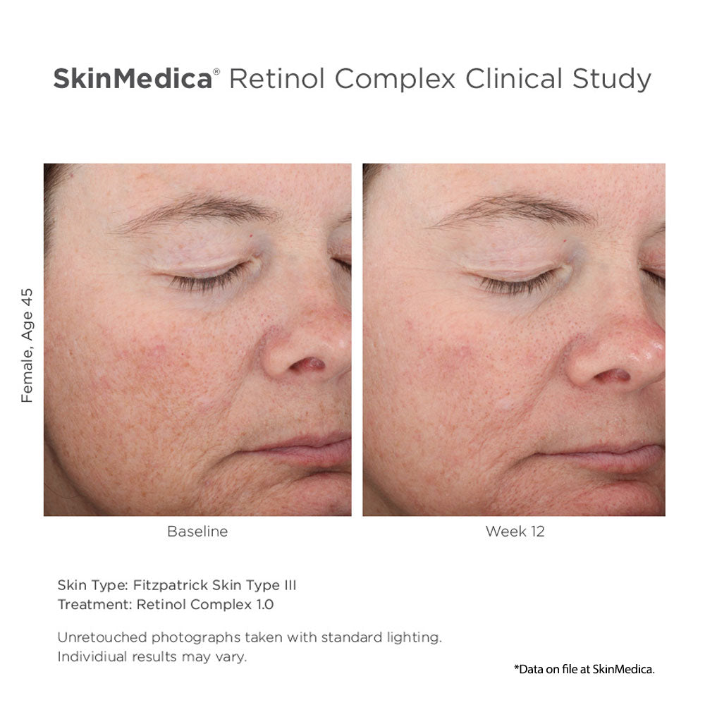 SkinMedica Retinol Complex results