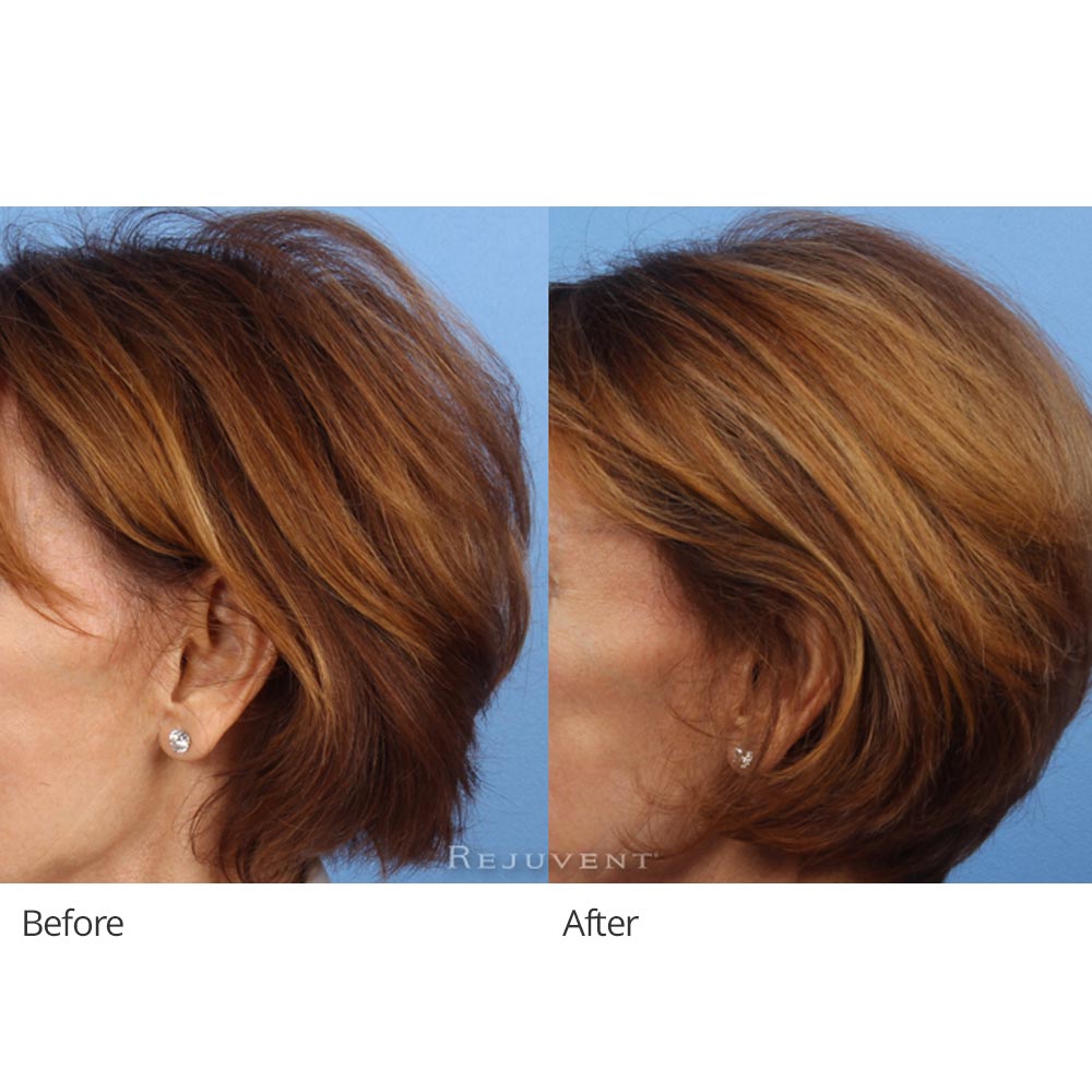 Viviscal Pro Hair Supplements side view results