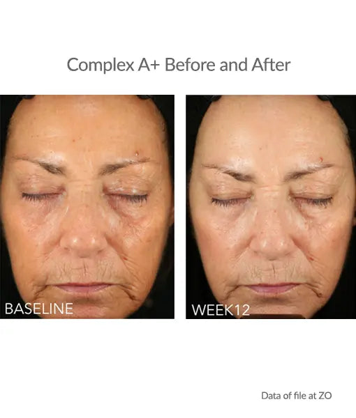 Before and after results after using ZO Complex A Retinol