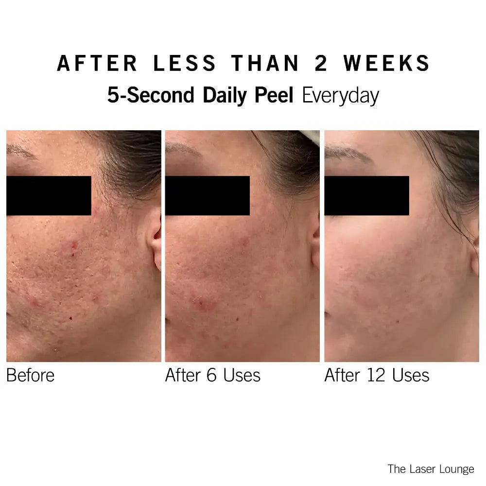 Neova SmartSkincare 5-Second Daily Peel