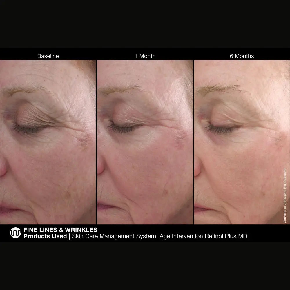 Marini SkinSolutions Retinol Plus XC (Extra Strength Retinol)