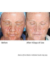 Alastin Skin Nectar results after 4 days of use