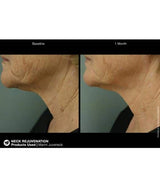 Jan Marini Juveneck Before and after