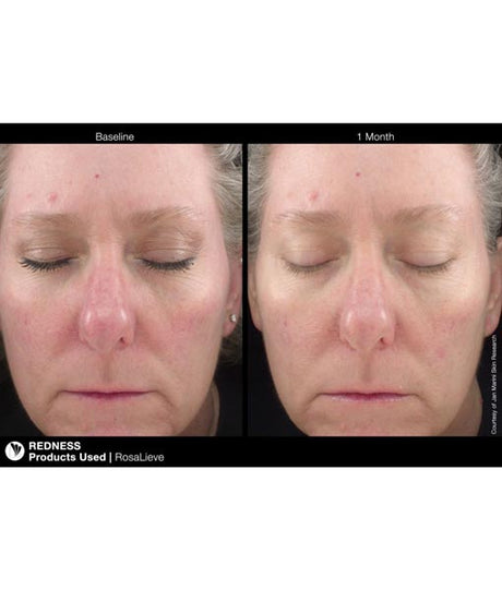 Jan Marini Rosalieve Before and after