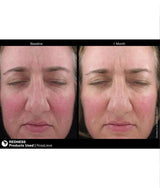Jan Marini Rosalieve Before and after 2