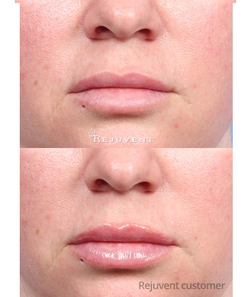 Clinicians Complex Lip Enhancer