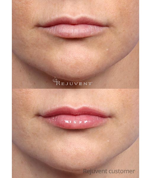 Clinicians Complex Lip Enhancer