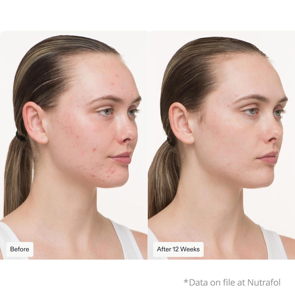 Nutrafol Clear Skin Before and After