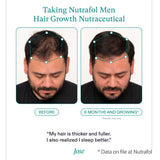 Nutrafol for Men before and after