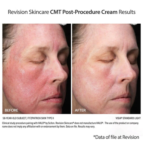 Revision Skincare CMT Post-Procedure Cream results show less redness and irritation post HALO treatment