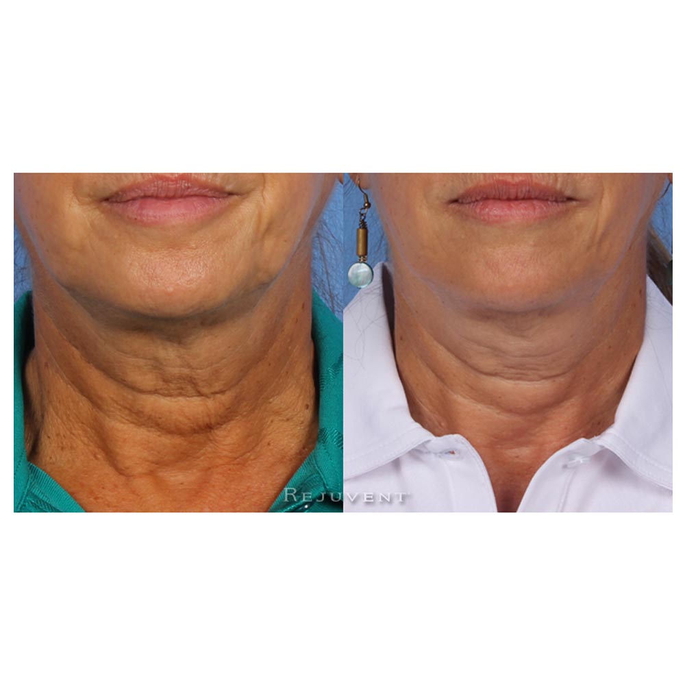 Revision Nectifirm Before and After results