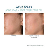 Silagen Acne Scar gel Results 3