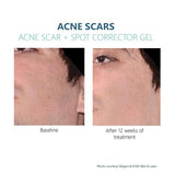 Silagen Acne Scar gel Results 4