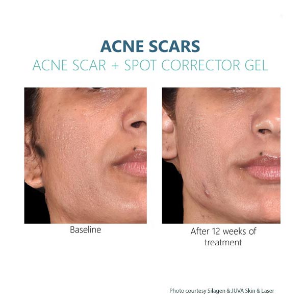 Silagen Acne Scar gel Results 5