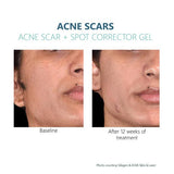 Silagen Acne Scar gel Results 5