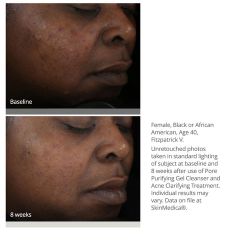 SkinMedica Acne Clarifying Treatment results on African American woman