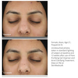 SkinMedica Acne Clarifying Treatment results on white woman