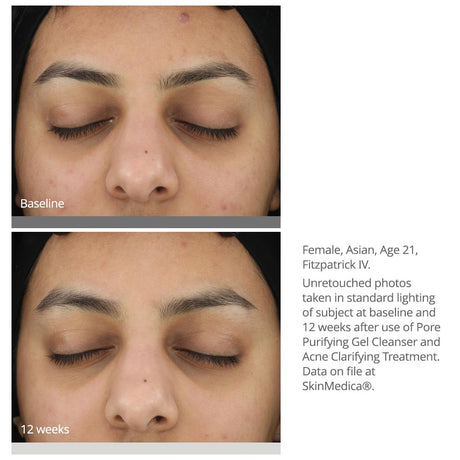 SkinMedica Acne Clarifying Treatment results on white woman