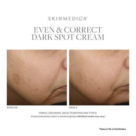 SkinMedica Even and Correct Advanced Brightening Serum results