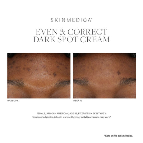 SkinMedica Even and Correct Advanced Brightening Serum results