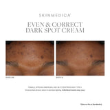 SkinMedica Even and Correct Dark Spot Cream Results on dark skin customer