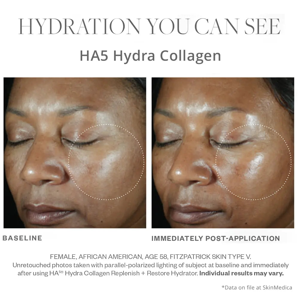 SkinMedica HA5 Hydra Collagen before and after results right after use