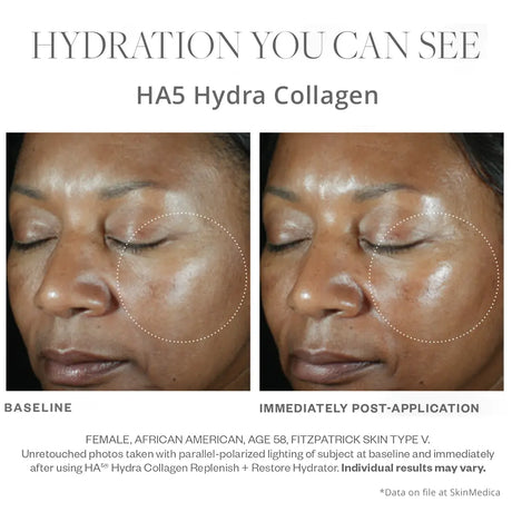 SkinMedica HA5 Hydra Collagen before and after results right after use