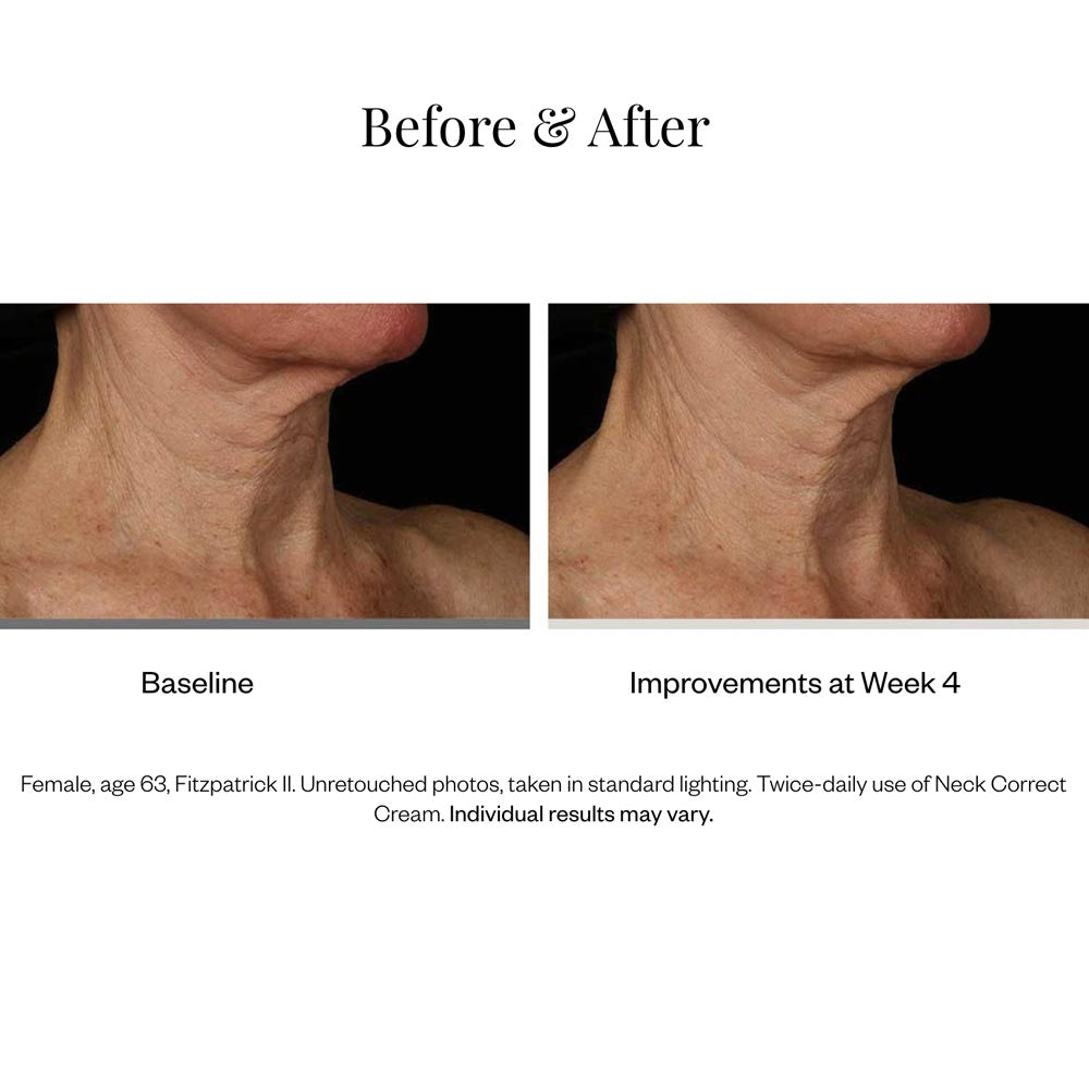 SkinMedica Neck Correct Cream results 1