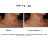 SkinMedica Neck Correct Cream results 2